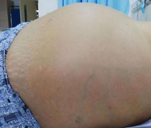 복수(Ascites) 관리 원칙왜 생기고 어떻게 조절할까?