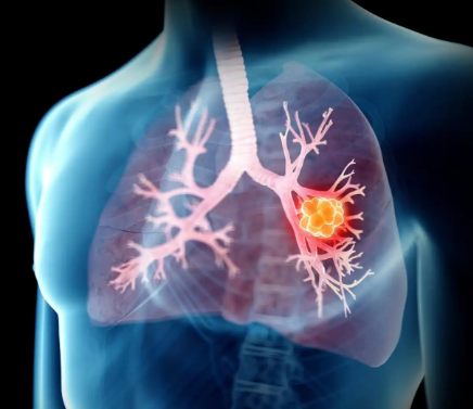 만성 폐쇄성 폐질환(COPD) 관리: 악화 예방과 호흡 재활 핵심 요령