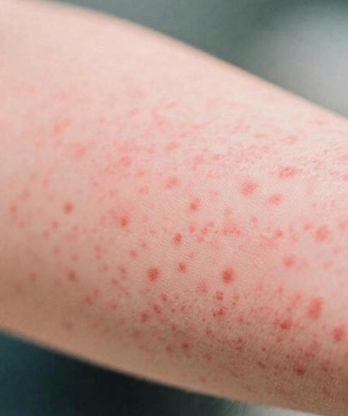 루푸스 전신홍반루푸스 증상과 진단