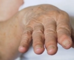 파킨슨병: 초기 신호와 진행 양상, 가장 먼저 나타나는 증상은?