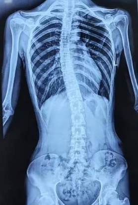 척추측만증 각도 기준별 올바른 치료 접근법