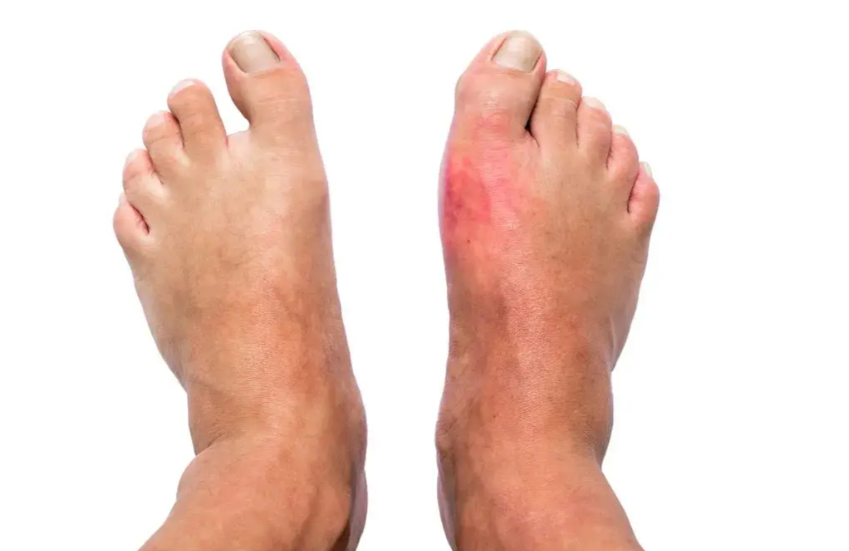 고요산혈증 무증상일 때 관리법, 방치하면 생기는 문제